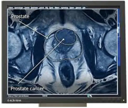 Weakly Supervised Prostate Cancer Prediction